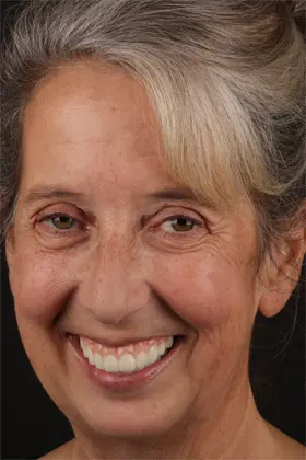 Patient thrilled with their new smile after reconstruction using dental implants